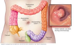 Colon Cancer Treatment in Electronic City
